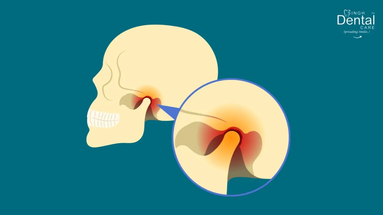 TMJ Disorders