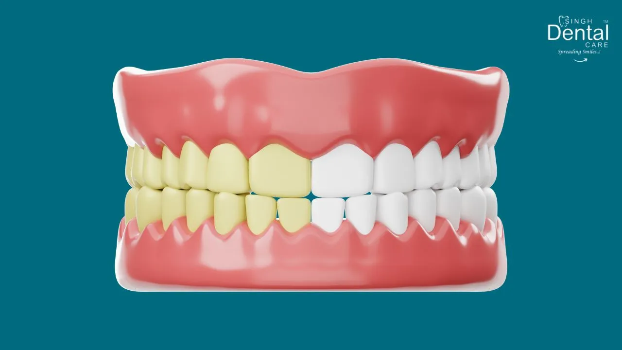 Teeth Whitening