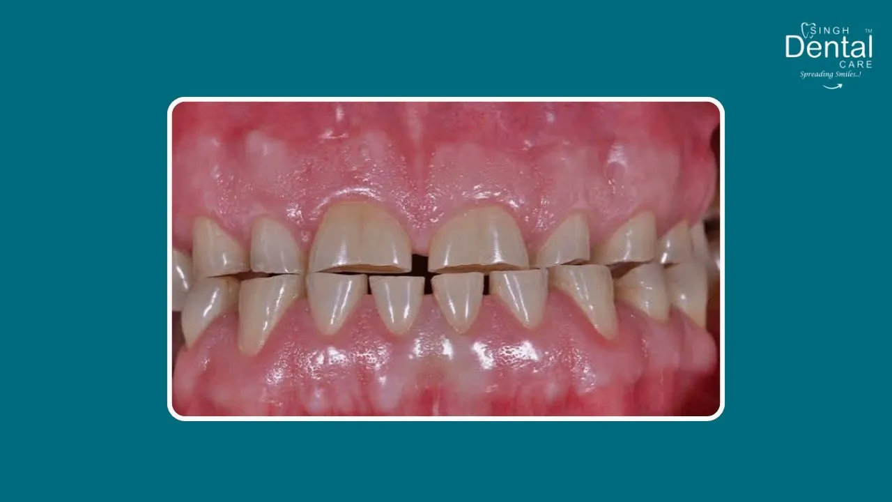 Attrition of tooth