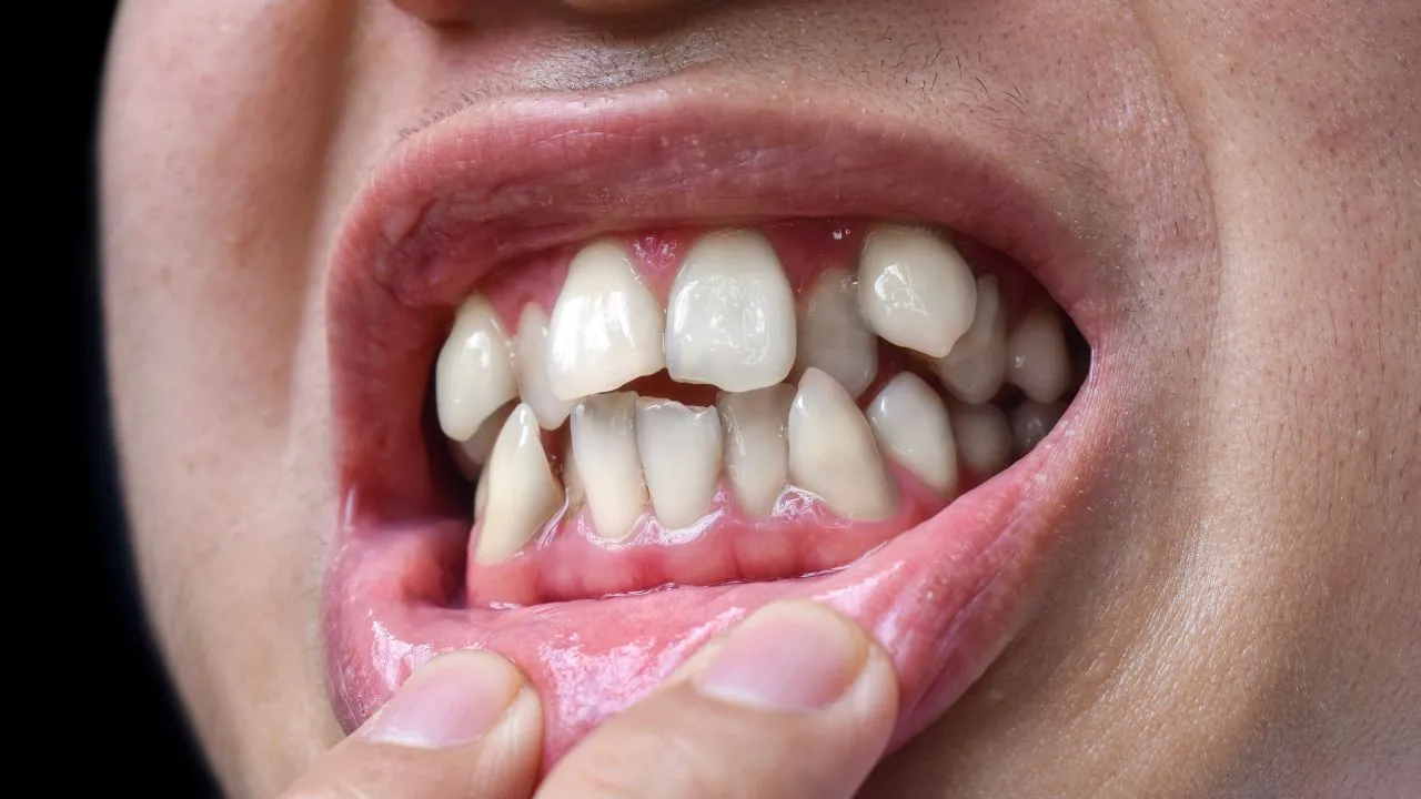 misaligned teeth
