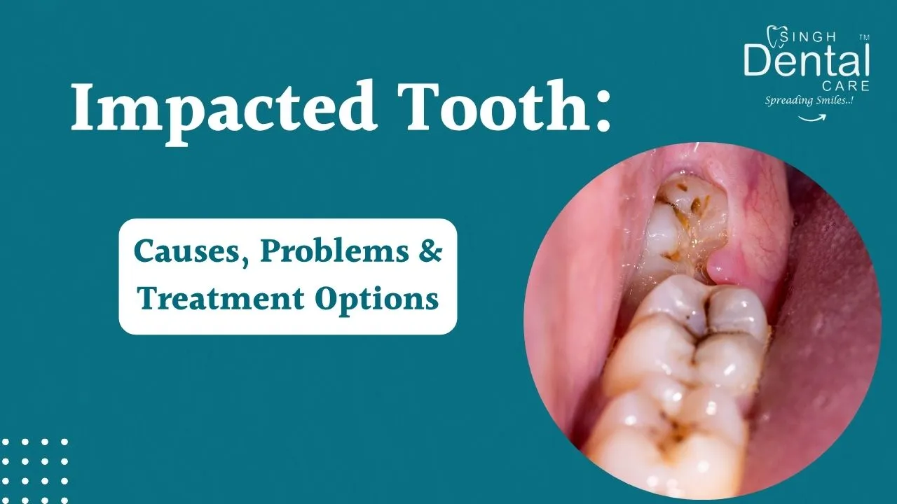 Impacted Tooth