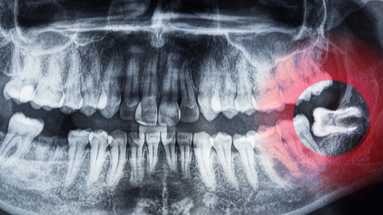 Impacted Tooth X-ray