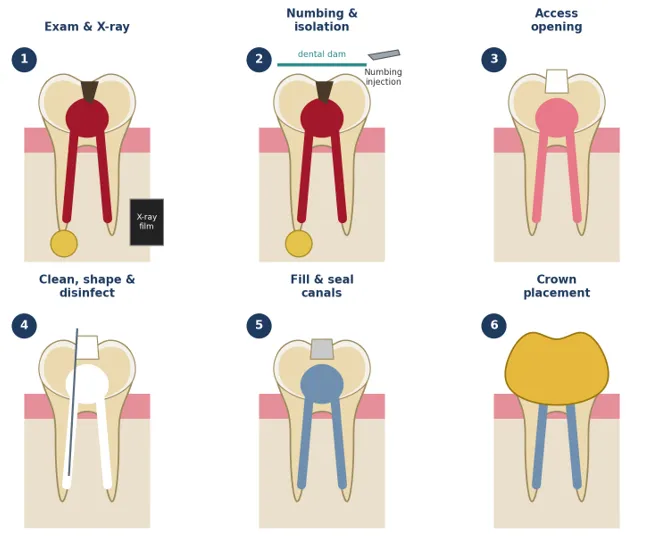 root canal treatment