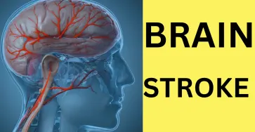 Brain stroke in hindi