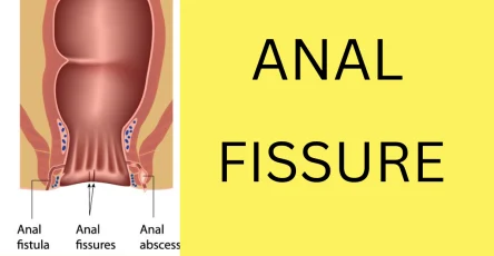 ANAL FISSURE