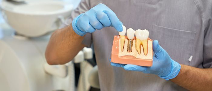 поставяне на зъбни импланти