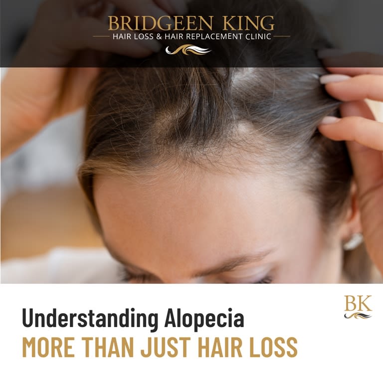 Understanding Alopecia – More Than Just Hair Loss
