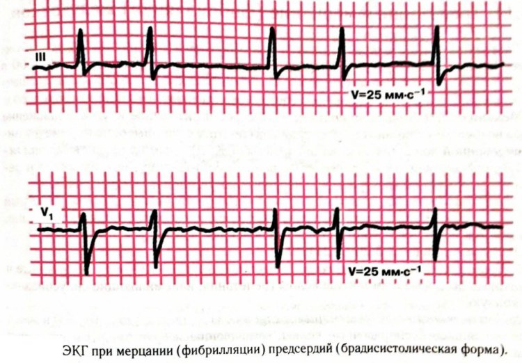 Как выглядит фибрилляция предсердий на экг фото