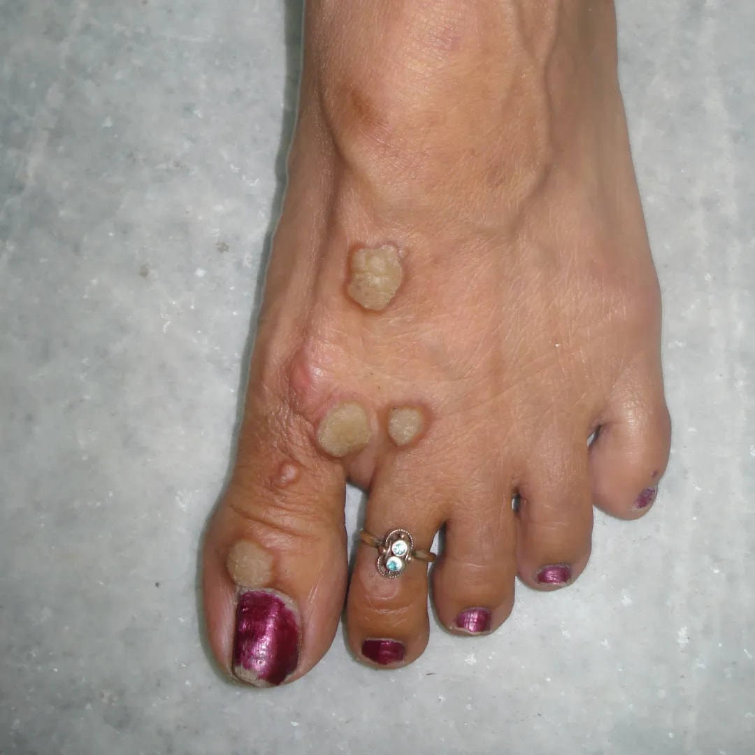 Warts