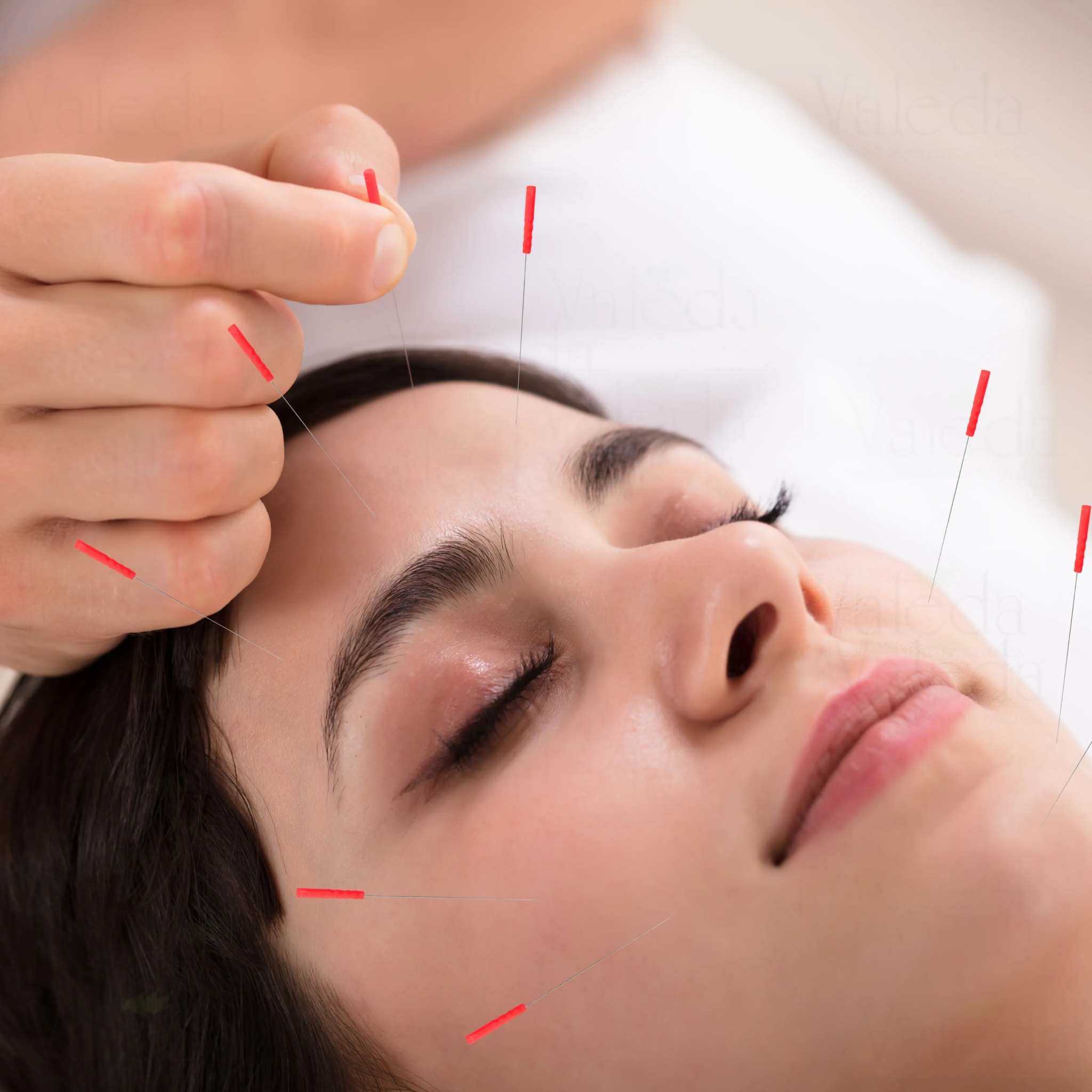 Acupuncture