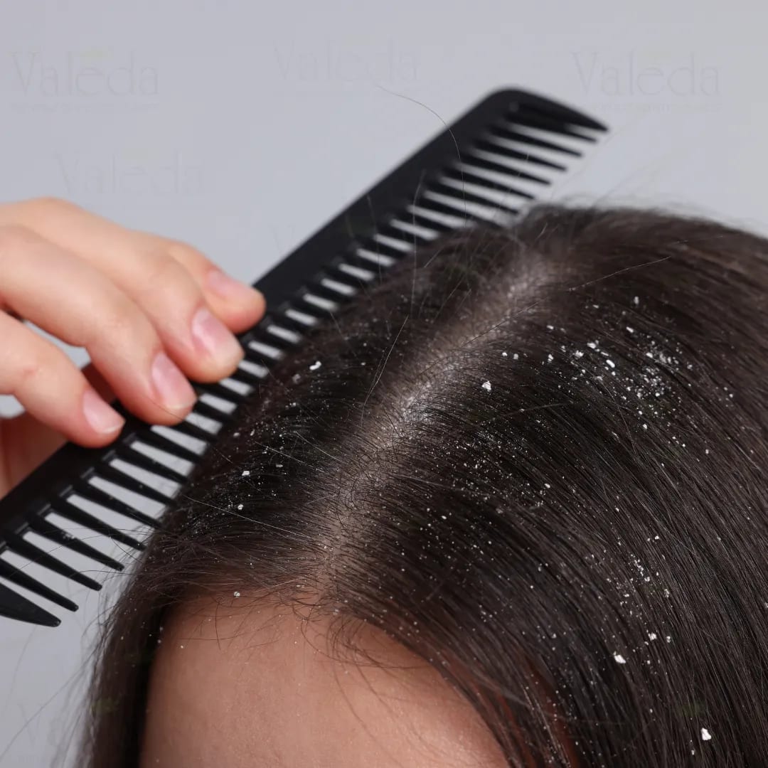 Dandruff