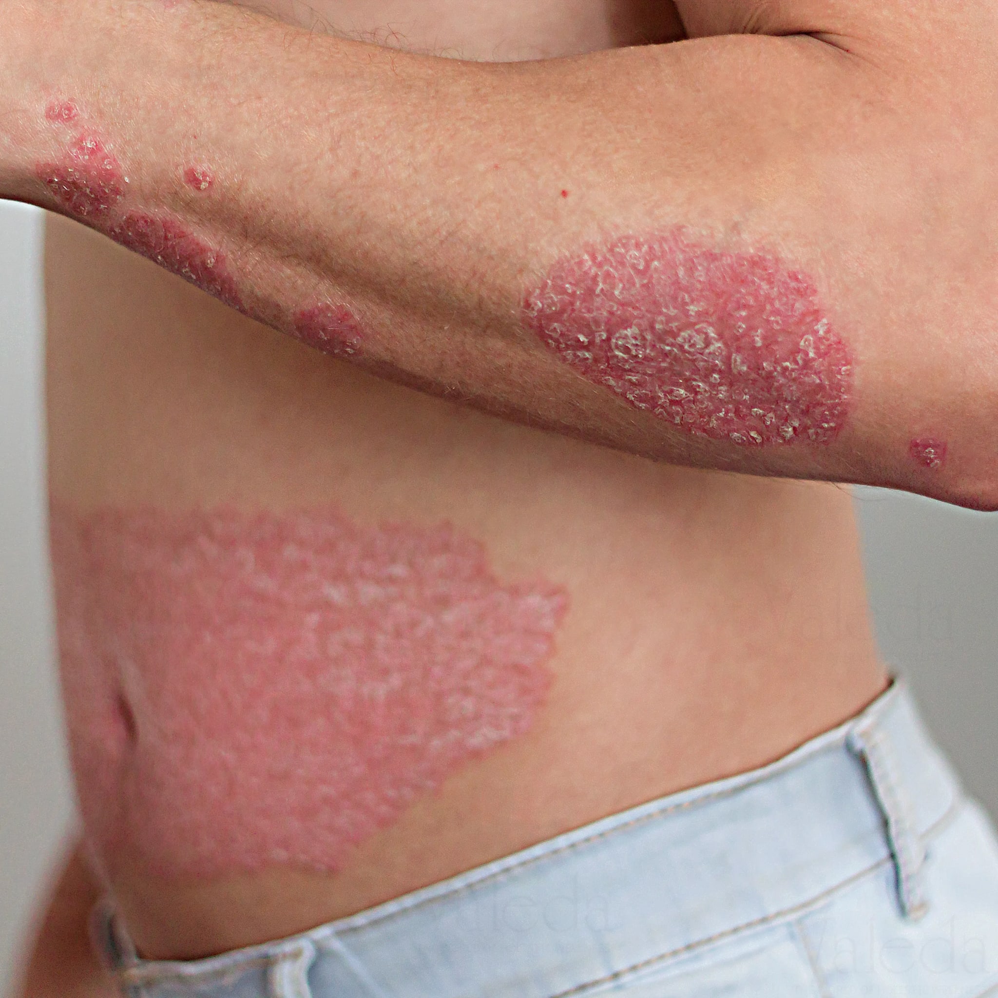Psoriasis