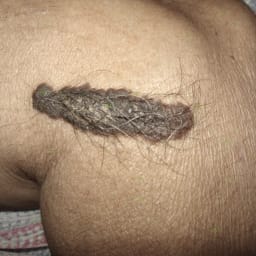 Birth Marks