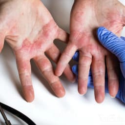 Eczema/Dermatitis