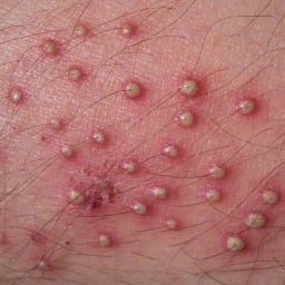 Folliculitis