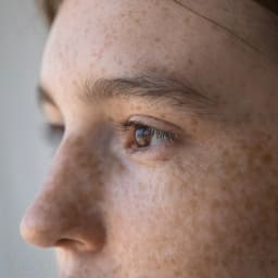 Freckles & Chloasma