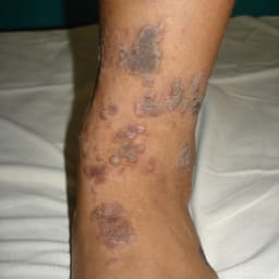 Lichen Planus