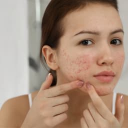 Acne/Pimples