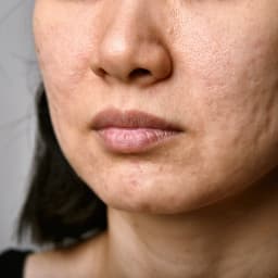 Post Acne Scars