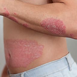 Psoriasis