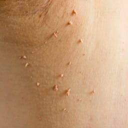 Skin Tags