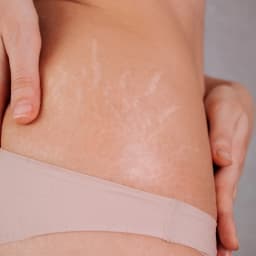 Stretch Marks