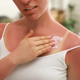 Sun Burn & Tanning
