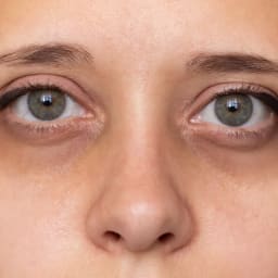 Undereye Circle