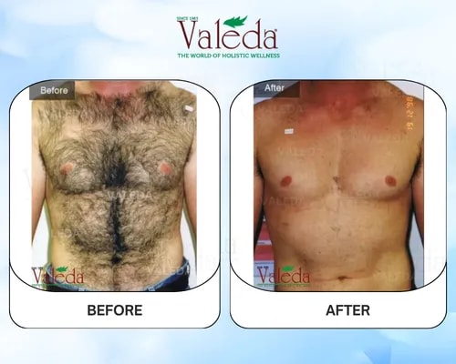 Permanent Hair Removal