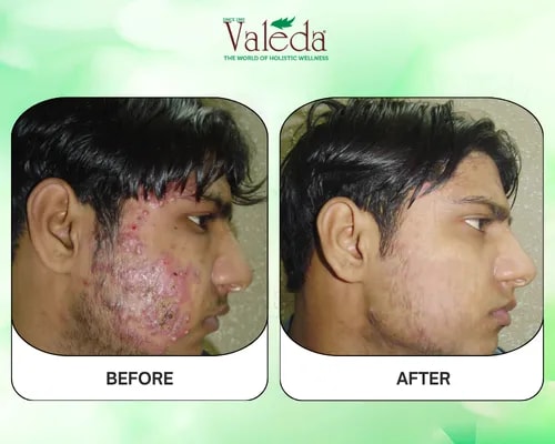 Before & After Pimples Treatment Results