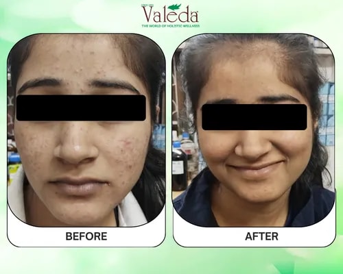 Before & After Pimples Treatment Results