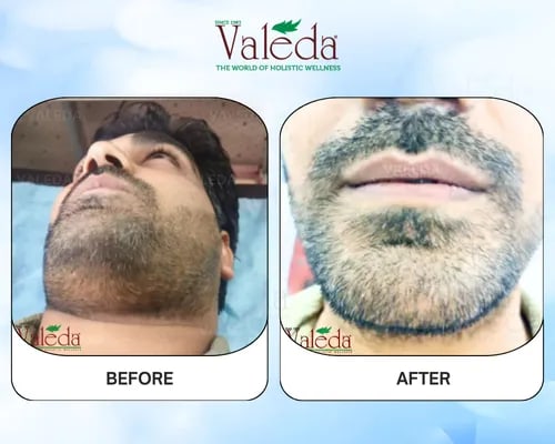 Permanent Hair Removal