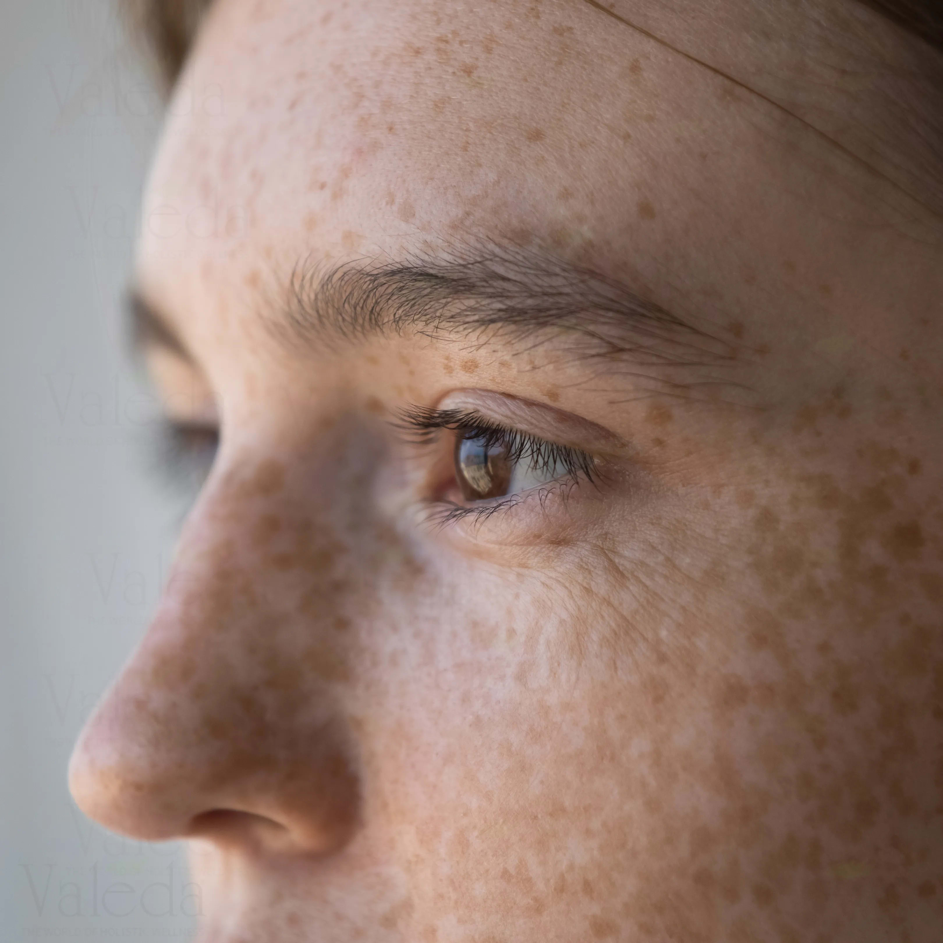 Freckles And Cholasma