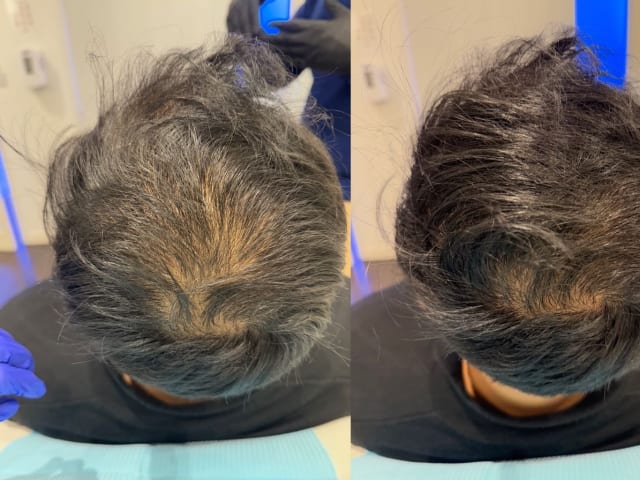 PRP & Oxygen Facial
