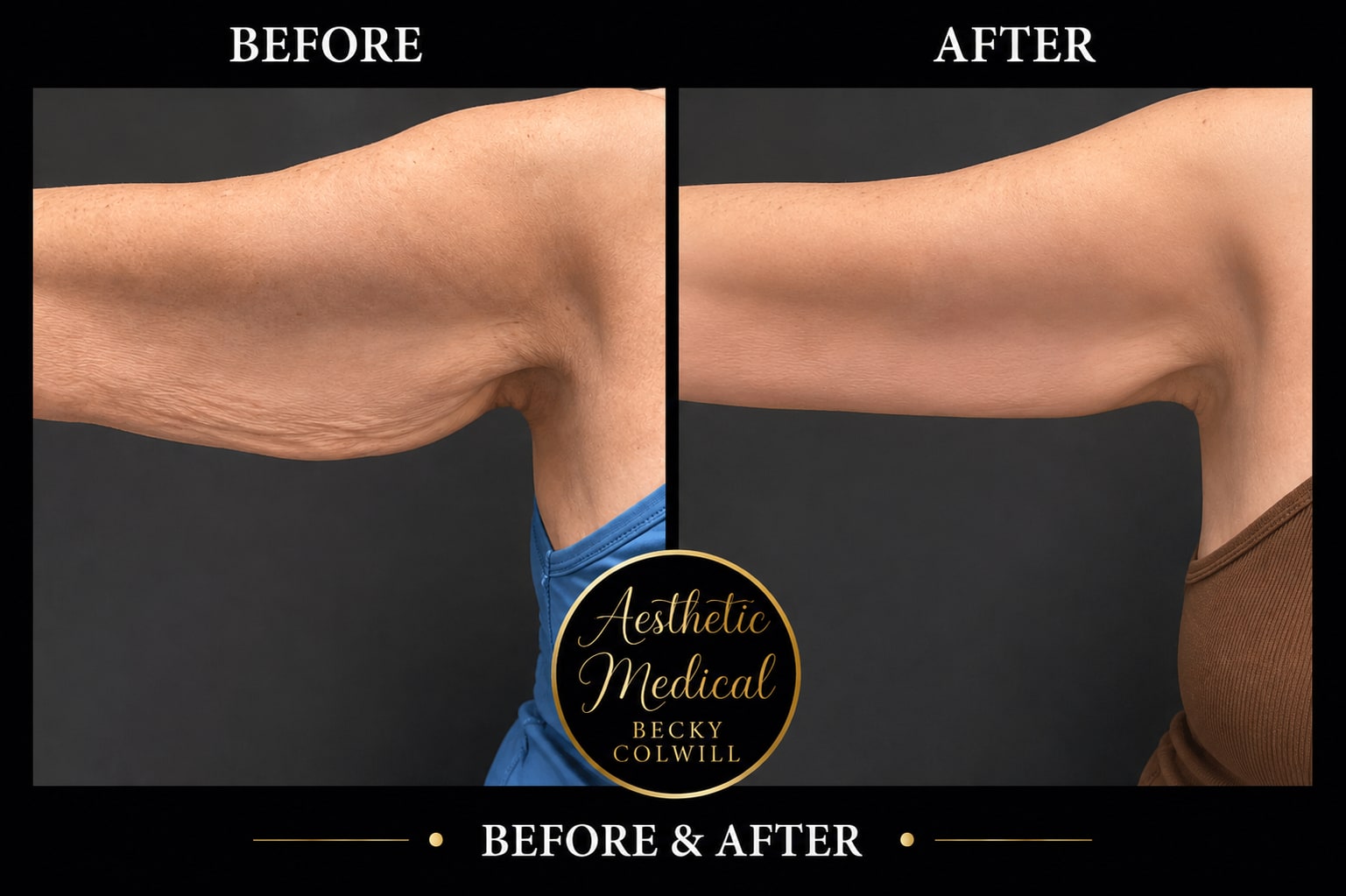Endolift arms before and after — Patient 1, real Aesthetic Medical Ltd patient
