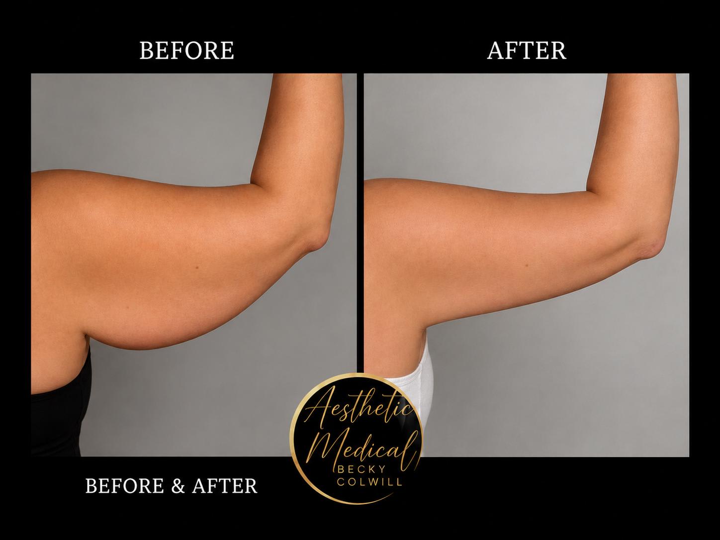 Endolift arms before and after — Patient 2, real Aesthetic Medical Ltd patient