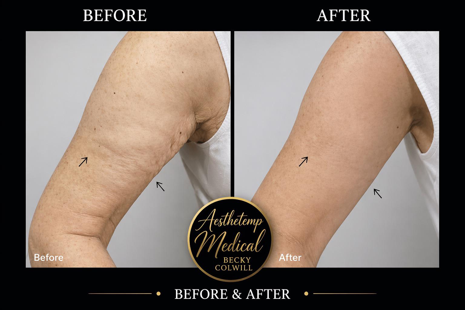 Endolift arms before and after — Patient 3, real Aesthetic Medical Ltd patient