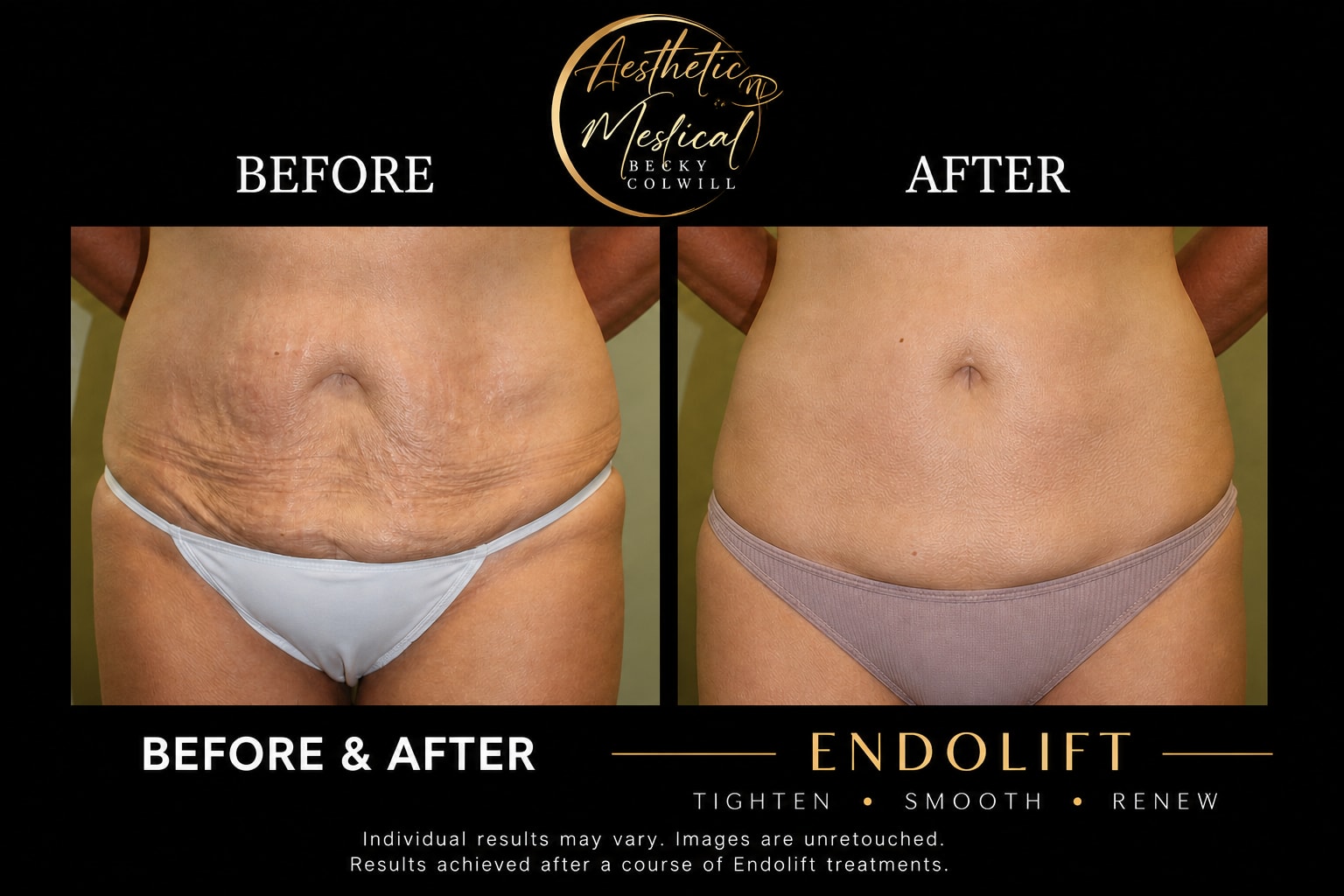 Endolift stomach before and after — real Aesthetic Medical Ltd patient with visible skin tightening and fat reduction