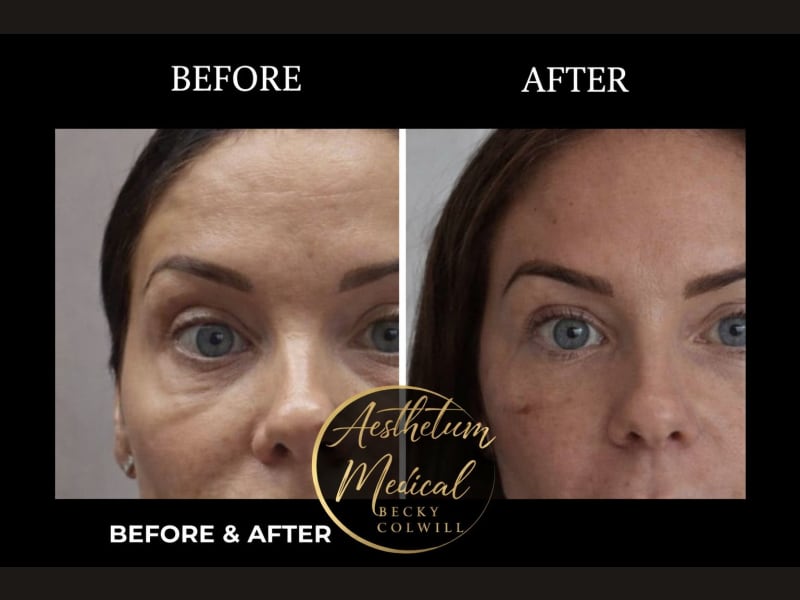 Endolift before and after — Eye Area Rejuvenation