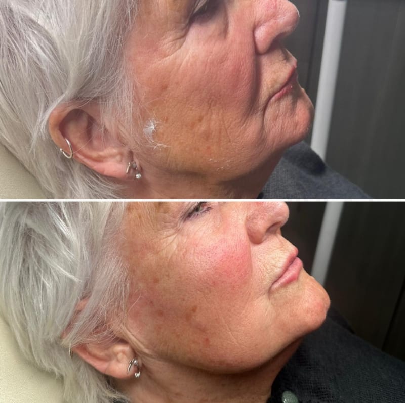 EndoPulse before and after — Ann, 74 — jawline and lower face