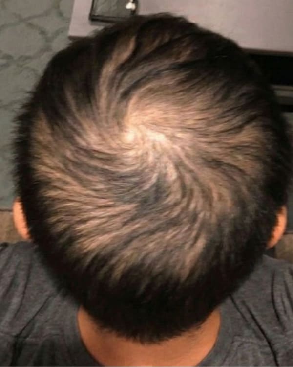 Before treatment