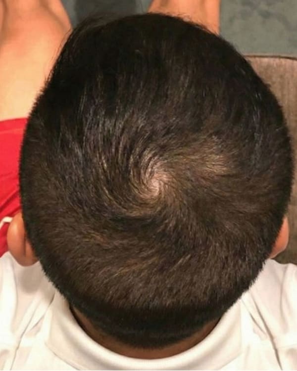 After treatment