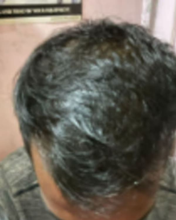 After treatment