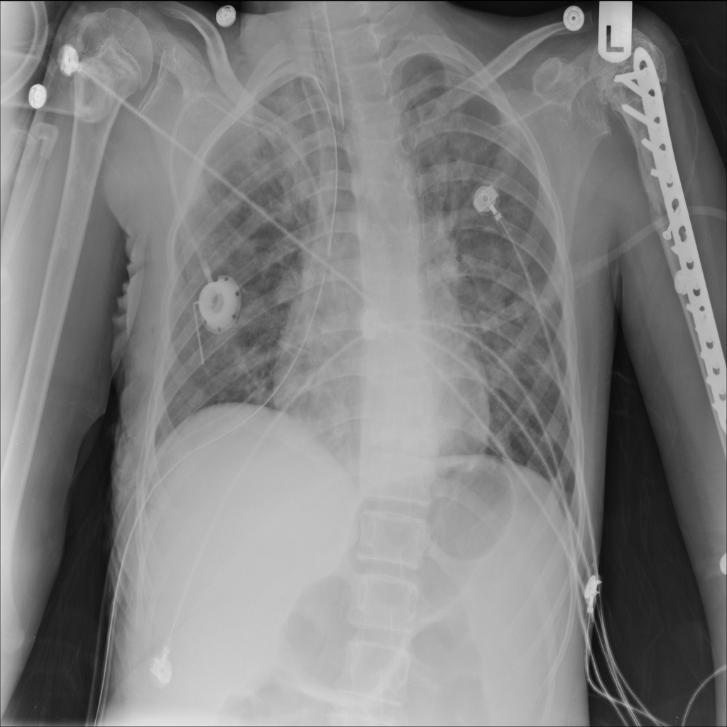 Chest X-Ray