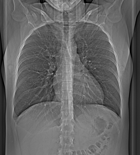 CT Scan