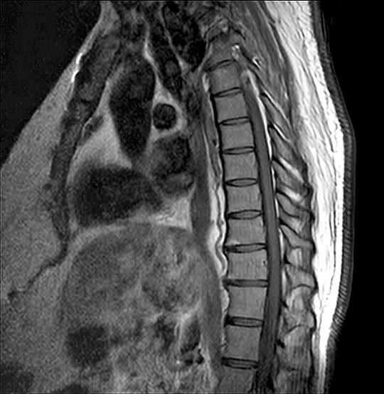 MRI