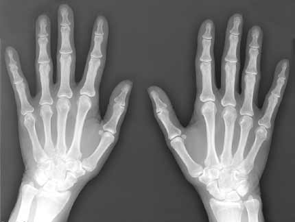 Bone X-Ray