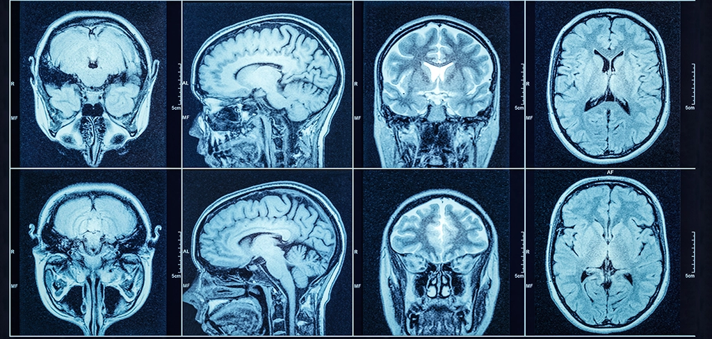 CT Scan