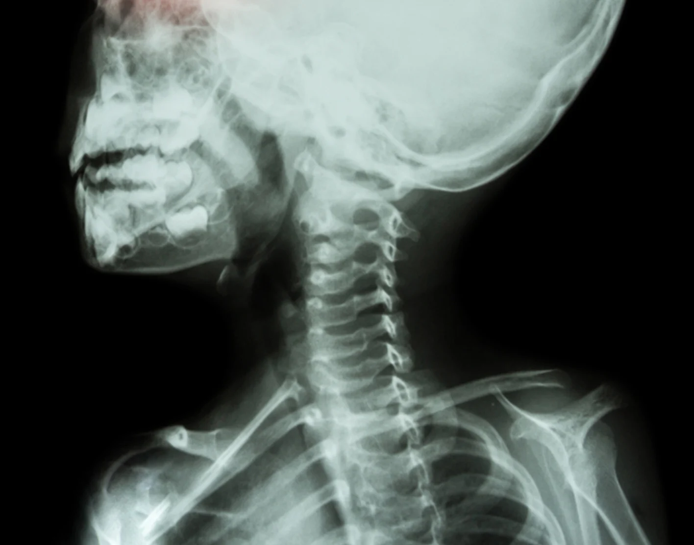 Bone X-Ray
