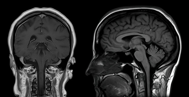 MRI